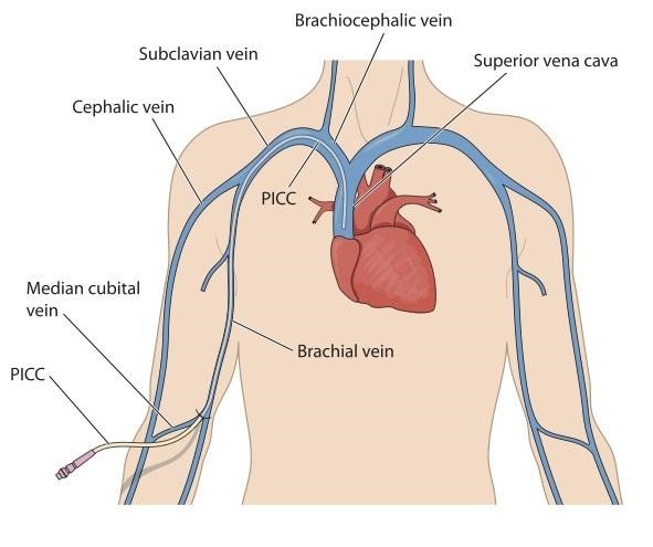 a simplified diagram of the human vascular system indicating where a PICC is inserted